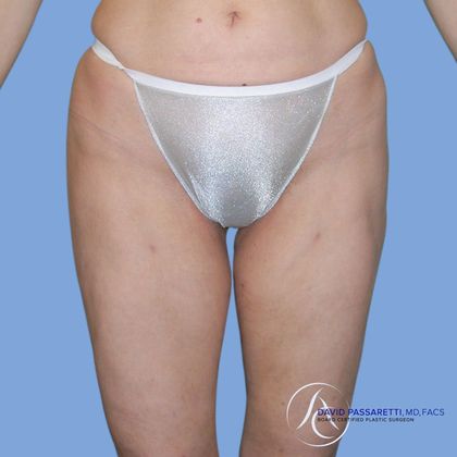 Liposuction Before & After