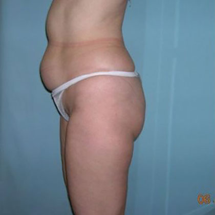 Liposuction Before & After