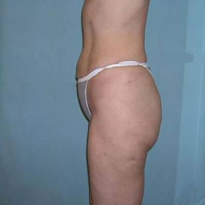 Liposuction Before & After