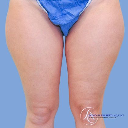 Liposuction Before & After