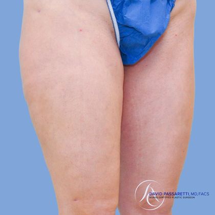 Liposuction Before & After