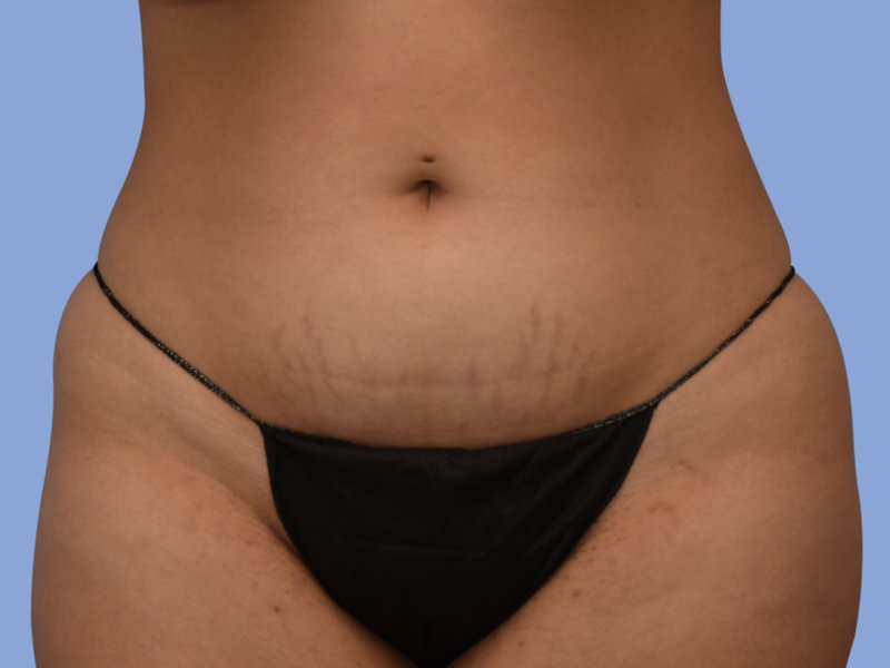 Liposuction Before & After