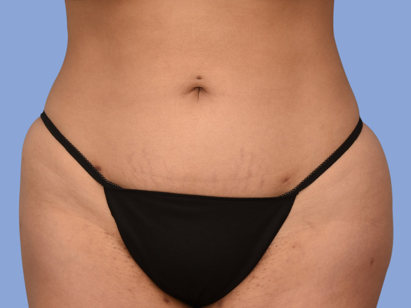 Liposuction Before & After
