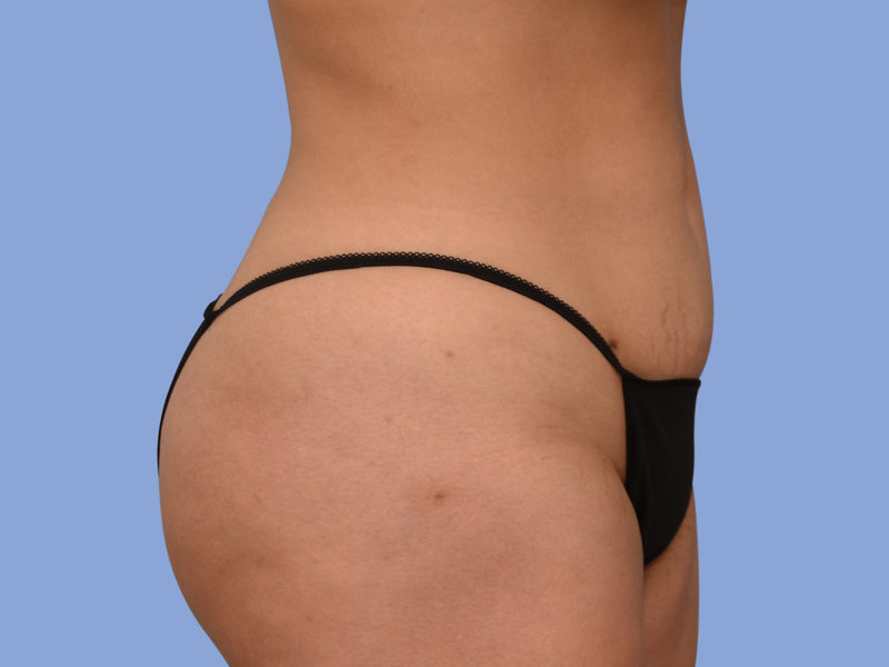 Liposuction Before & After