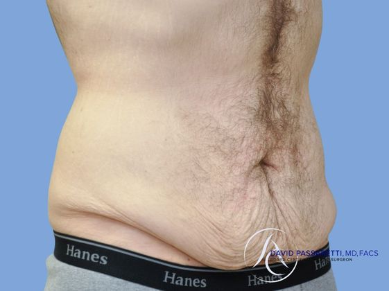 Post bariatric surgery Before & After