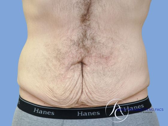 Post bariatric surgery Before & After