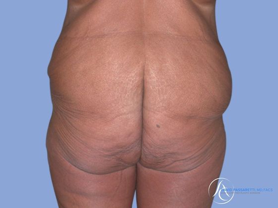 Post bariatric surgery Before & After