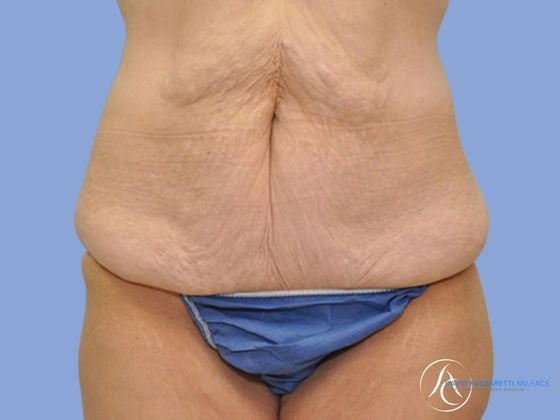 Post bariatric surgery Before & After