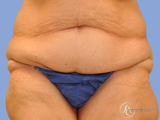 Post bariatric surgery Before & After