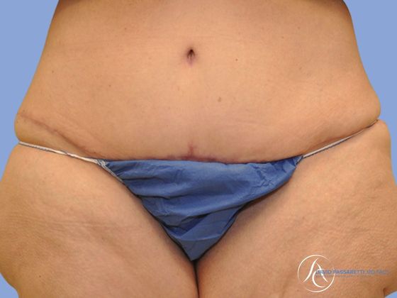 Post bariatric surgery Before & After