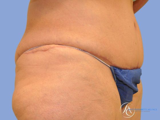 Post bariatric surgery Before & After