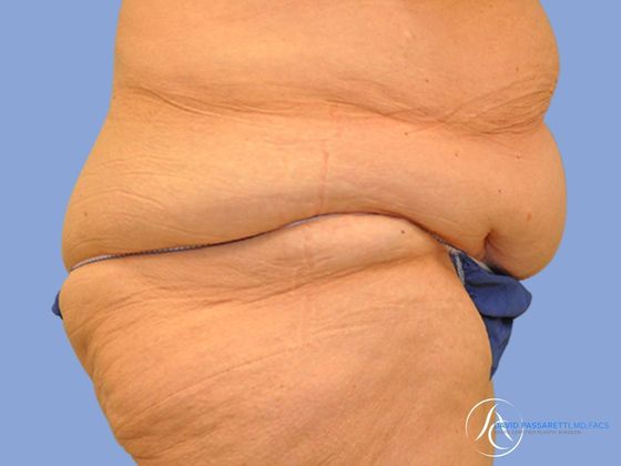 Post bariatric surgery Before & After