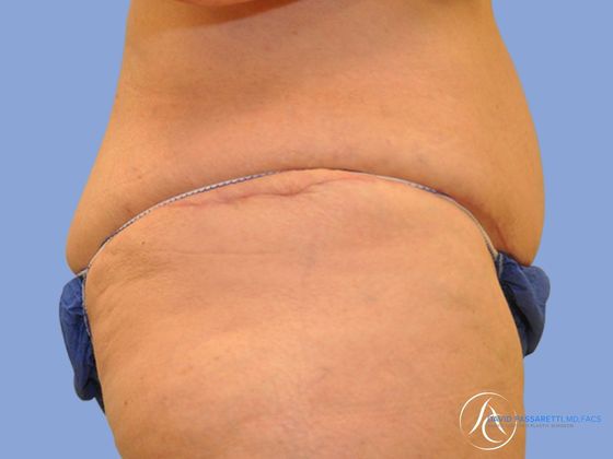 Post bariatric surgery Before & After