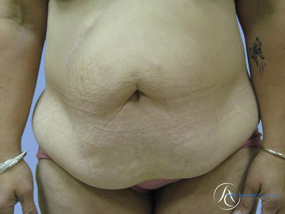 Post weight loss Before & After