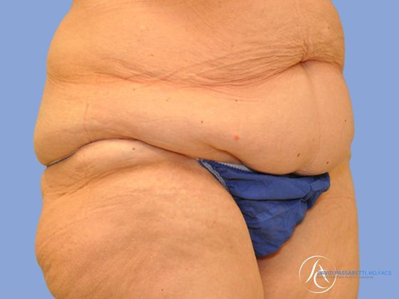 Post weight loss Before & After