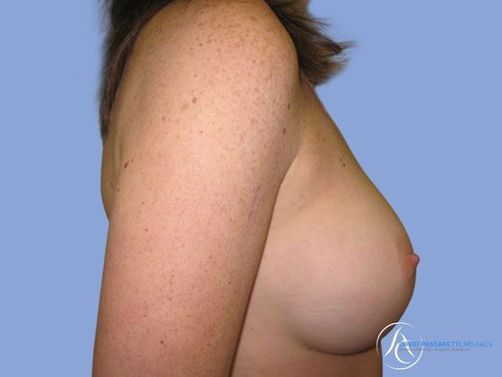 Breast augmentation Before & After