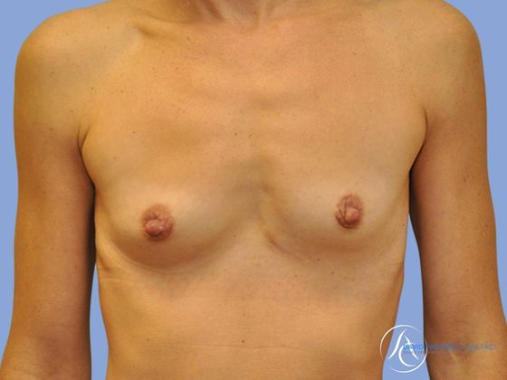 Breast augmentation Before & After