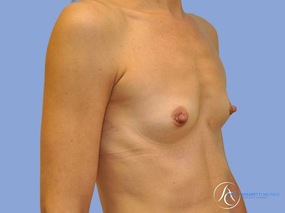 Breast augmentation Before & After
