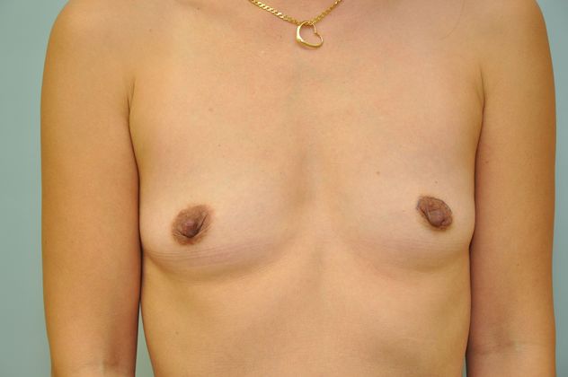 Breast augmentation Before & After