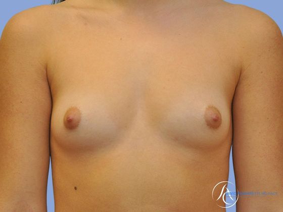 Breast augmentation Before & After