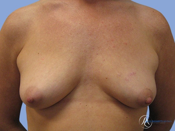 Breast augmentation Before & After