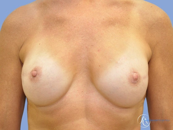 Breast augmentation Before & After