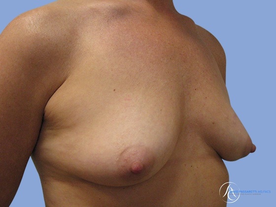 Breast augmentation Before & After