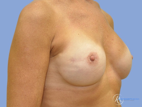 Breast augmentation Before & After