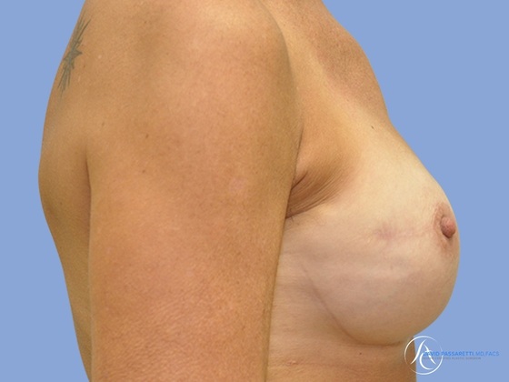 Breast augmentation Before & After