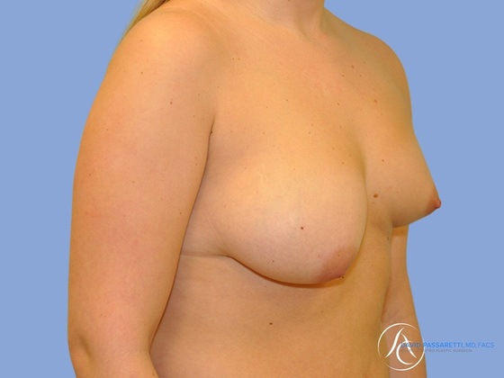 Breast augmentation Before & After