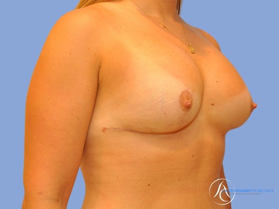 Breast augmentation Before & After