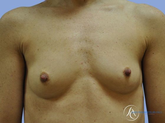 Breast augmentation Before & After