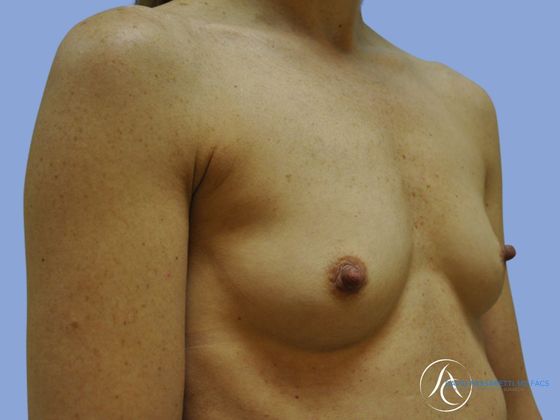 Breast augmentation Before & After