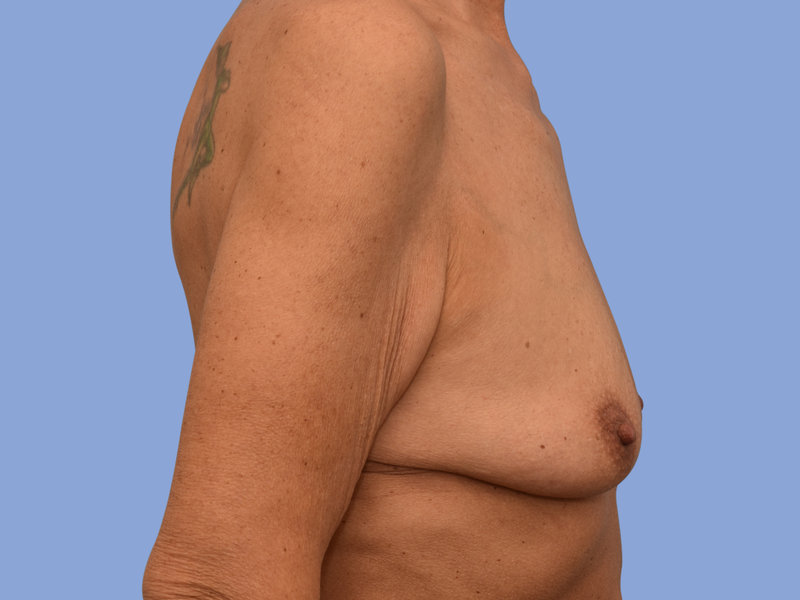 Breast augmentation Before & After