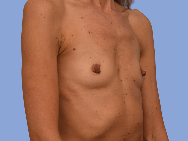 Breast augmentation Before & After