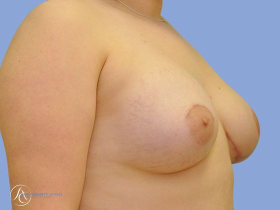 Breast implant revision Before & After