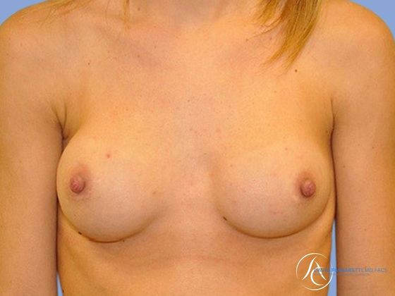 Breast implant revision Before & After