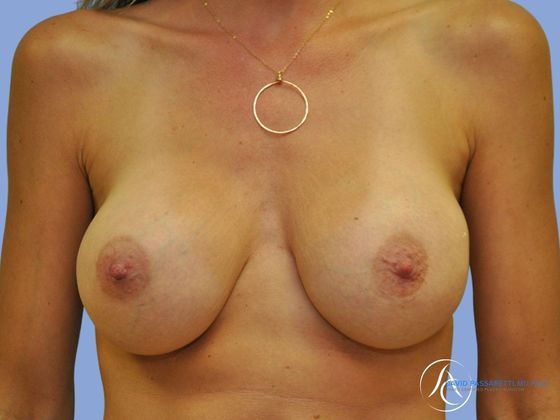 Breast implant revision Before & After