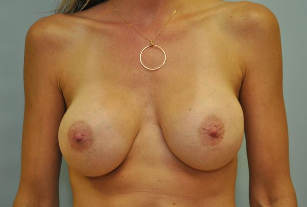 Breast implant revision Before & After