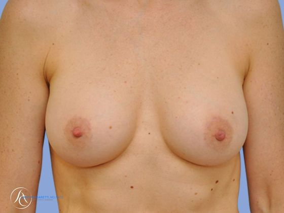 Breast implant revision Before & After