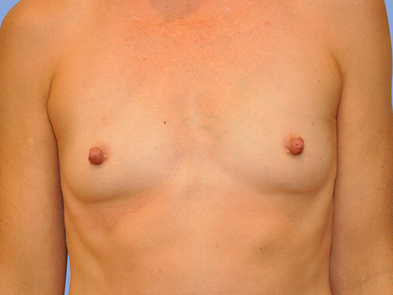 Breast reconstruction Before & After