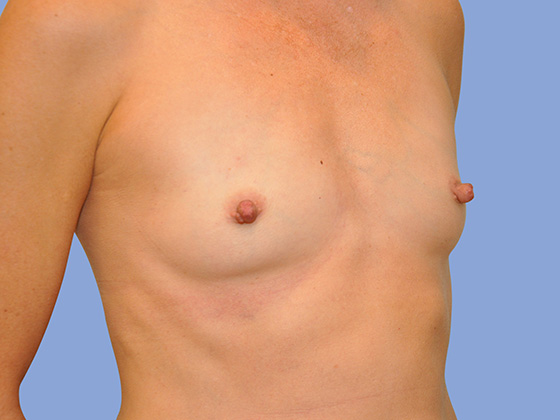 Breast reconstruction Before & After