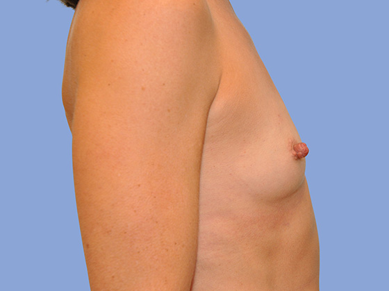 Breast reconstruction Before & After