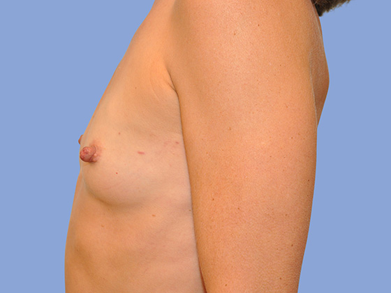 Breast reconstruction Before & After