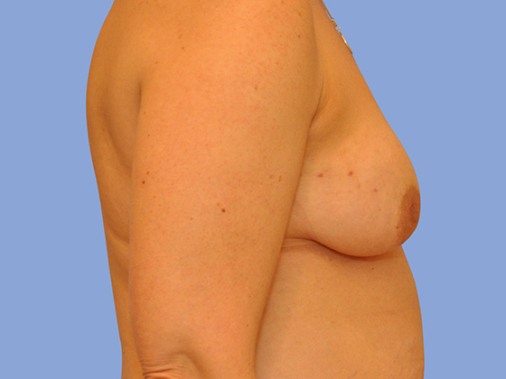 Breast reconstruction Before & After