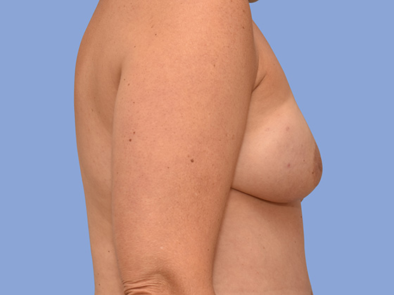 Breast reconstruction Before & After