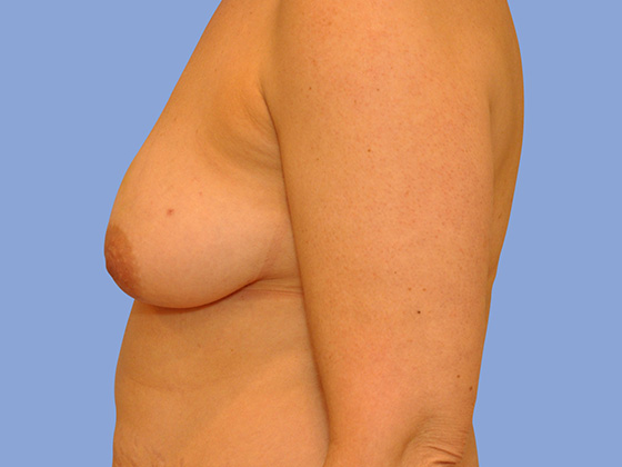 Breast reconstruction Before & After