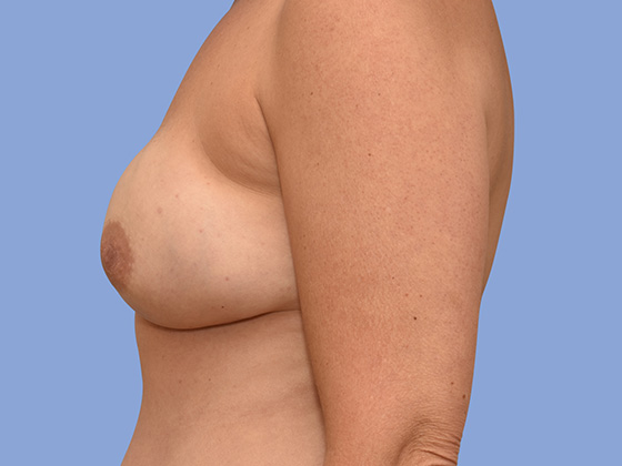 Breast reconstruction Before & After