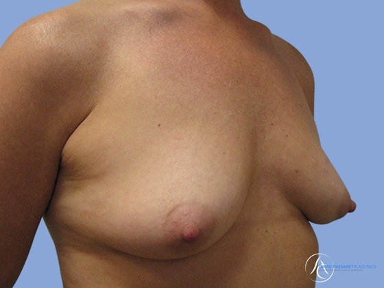 Breast reconstruction Before & After
