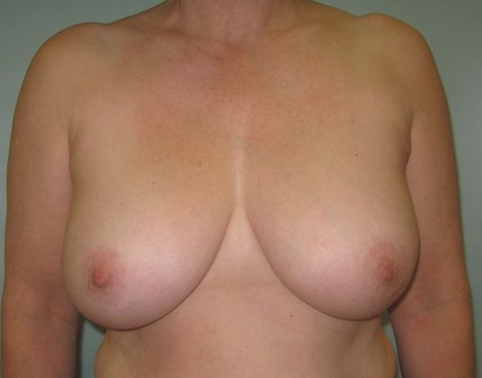 Breast reconstruction Before & After